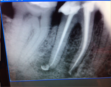 Endodonzia - Ozeta Dental Center