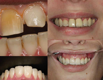 Protesi fissa - Ozeta Dental Center